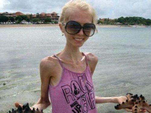 瘦成干尸的少女Kseniya Bubenko 世界上最瘦的人体重仅20公斤（患厌食症）