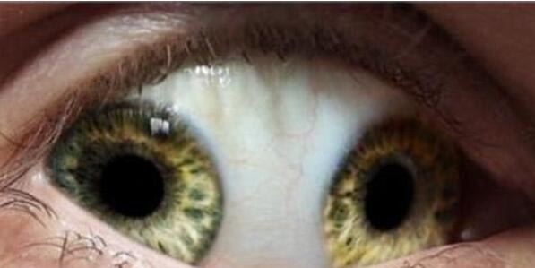 世界十大最恐怖的眼球 双瞳孔眼乃绝世罕见(胆小慎入)