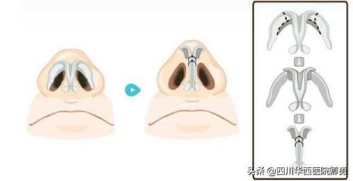鼻翼缩小术三种常见方法 缩小鼻翼的方法