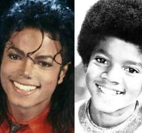 迈克尔杰克逊皮肤病之前和之后的对比