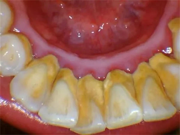 牙缝里的牙结石怎么去除(牢记这三个方法)